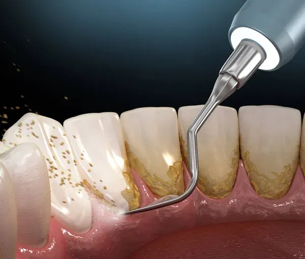 Preventive dental cleaning before and after treatment